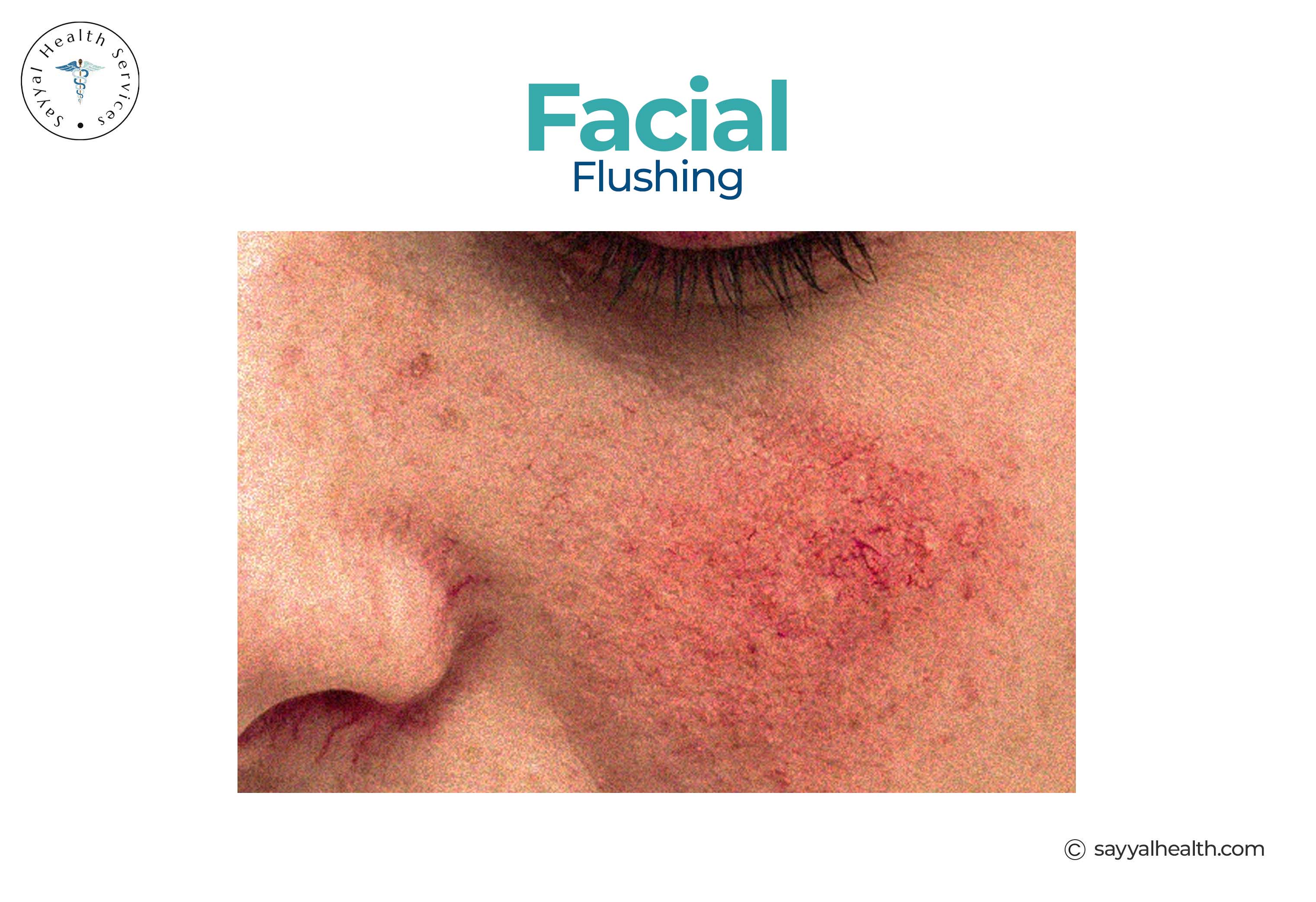 Close-up of facial flushing and redness on cheek